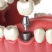Implante dentário: o que é, tipos, cuidados e TUDO sobre o assunto