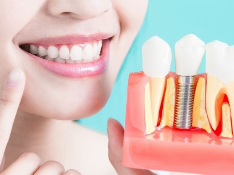 Implantes dentários: qual o procedimento?