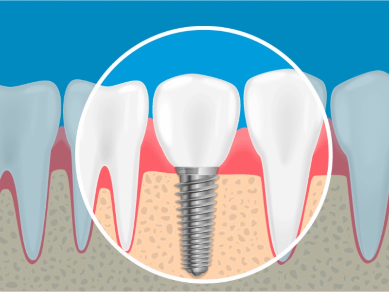 Implante Dentário