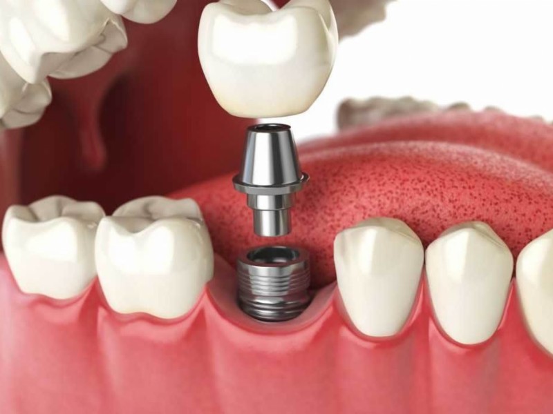 Implante dentário: o que é, tipos, cuidados e TUDO sobre o assunto